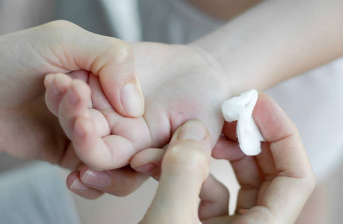 How to Remove a Splinter