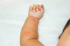 Mosquitoes Are on the Rise…and So Are Insect-Borne Diseases