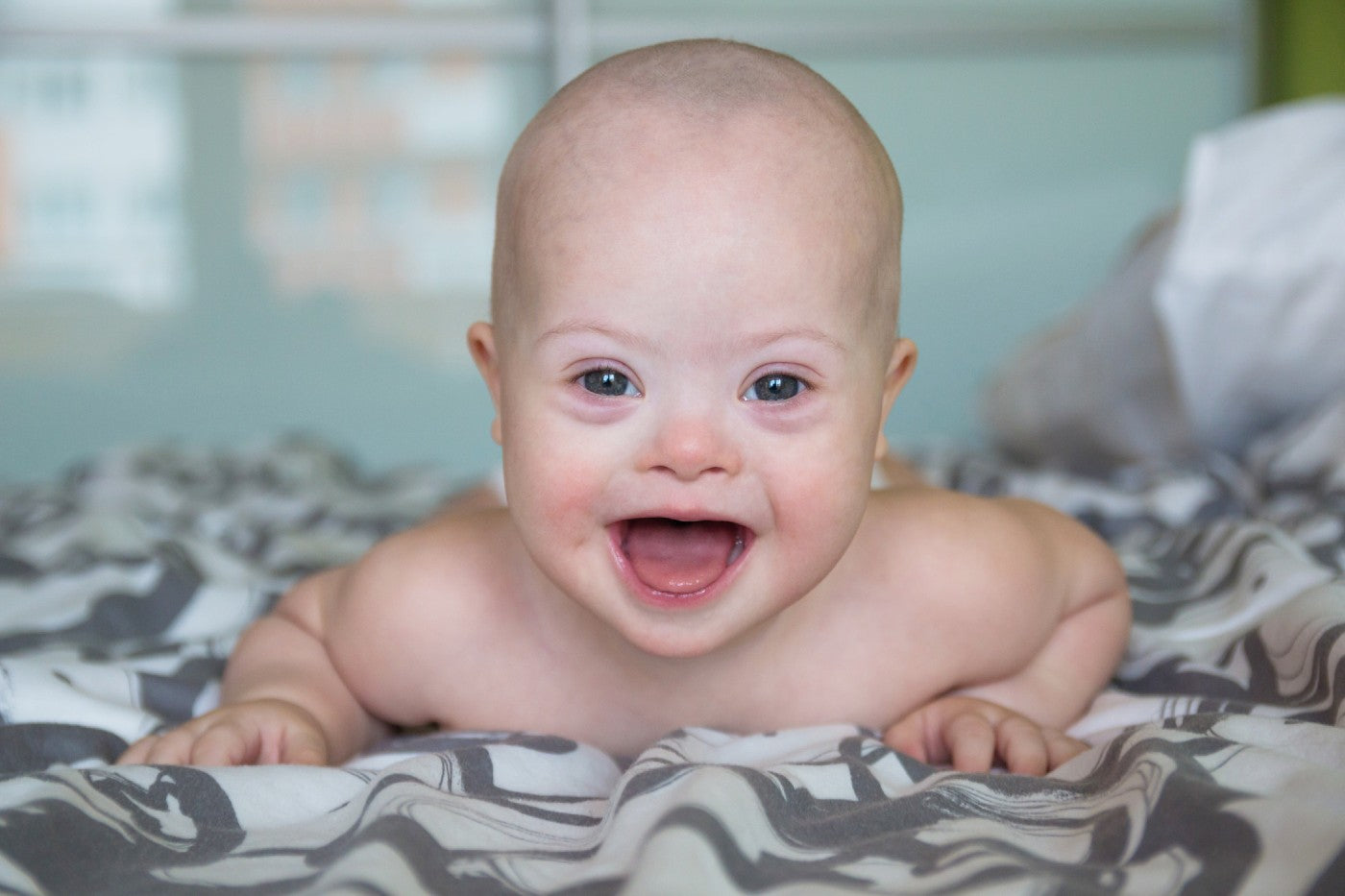 Physical Appearance Sanfilippo Syndrome Baby
