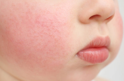 What to Know About Fifth Disease in Babies and Kids