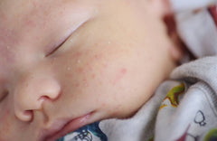 Baby Acne: What to Do About Infant Pimples