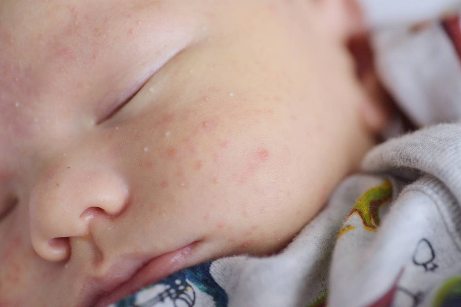Baby Acne Treatment and Causes Happiest Baby