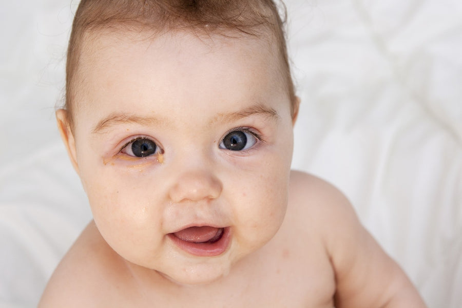 Pink Eye in Babies and Toddlers Symptoms and Treatment Happiest Baby